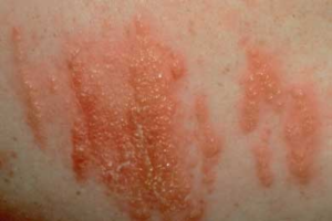 how to safely remove poison ivy